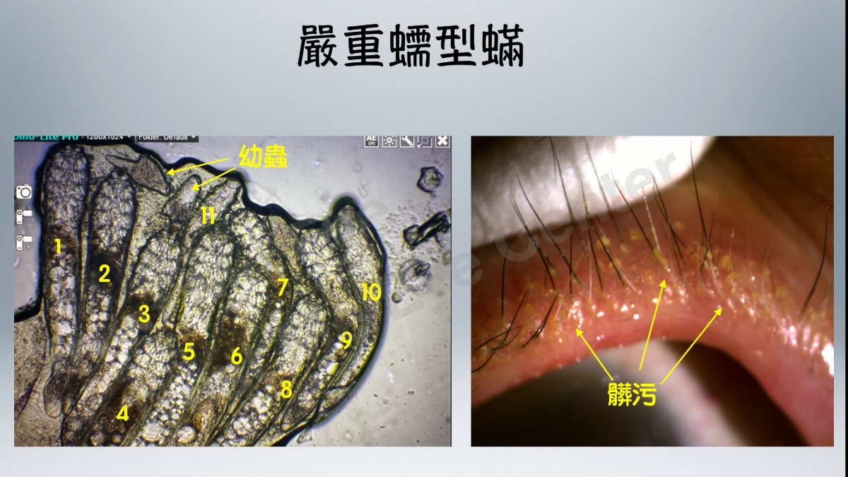 醫起看／驚悚畫面！她眼睛發癢難耐 醫嚇曝有「11隻蟲爬動 」