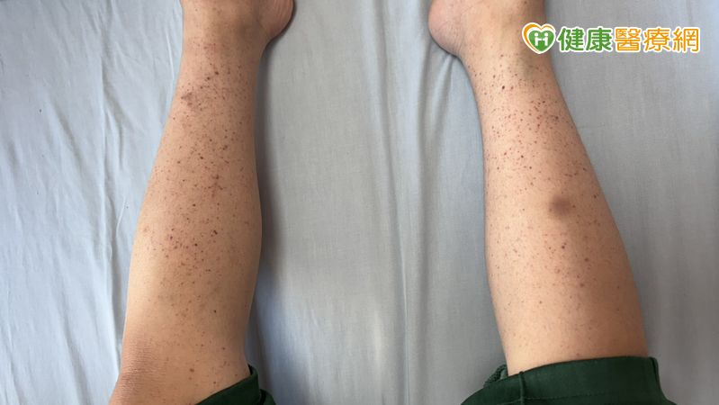 8歲童全身冒小血斑、剔牙大出血　竟是「免疫性紫斑症」險致命's story cover image