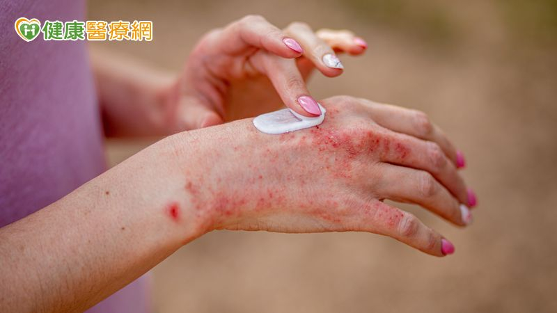 異位性皮膚炎怎麼用藥和吃穿？醫師一一告訴你's story cover image