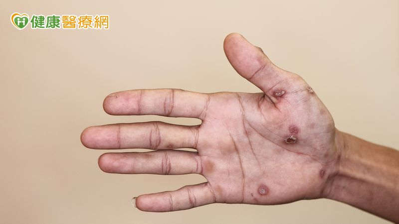 手腳紅斑不癢！他問AI竟罹「梅毒二期」　醫點頭揭成因's story cover image