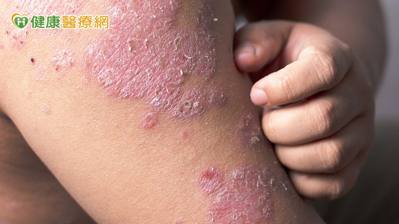 抓到滿身傷還治不好？醫揭「異位性皮膚炎關鍵解方」重拾生活品質's story cover image