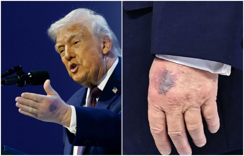 川普左手背又冒大片瘀青!白宮這回這樣解釋 79歲健康狀況再引關注's OG Image
